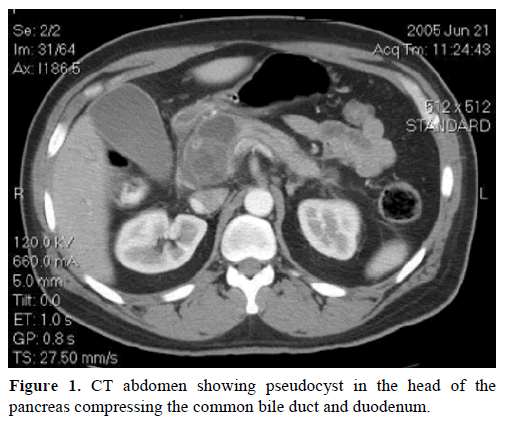 pancreas-ct-abdomen-pseudocyst
