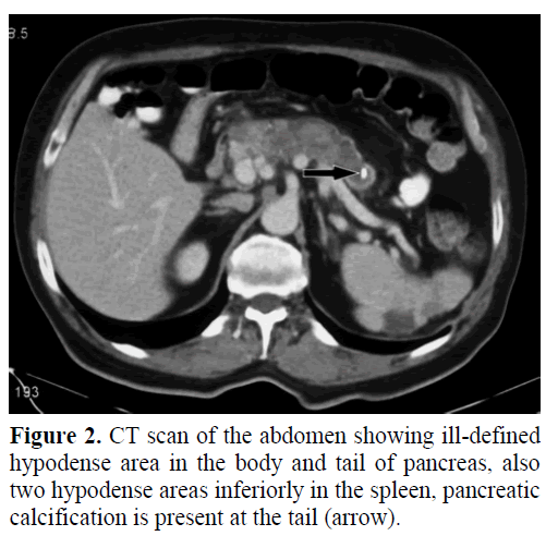 pancreas-ct-scan-abdomen-hypodense-area