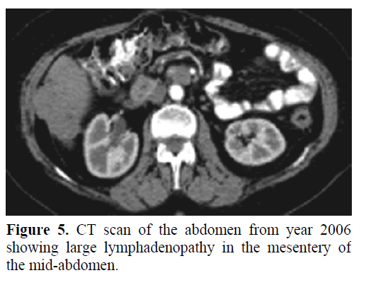 pancreas-ct-scan-abdomen-lymphadenopathy