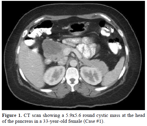 pancreas-ct-scan-round-cystic-mass