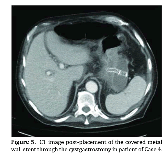 pancreas-cystgastrostomy-patient