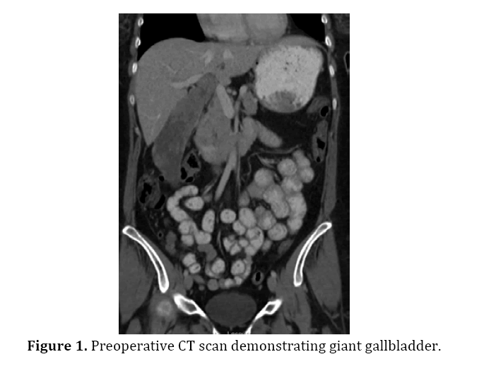 pancreas-demonstrating-giant-gallbladder