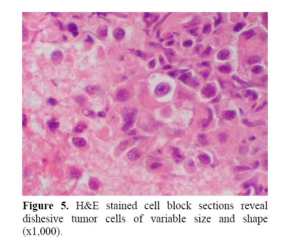 pancreas-dishesive-tumor-cells
