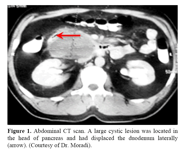 pancreas-displaced-duodenum-laterally