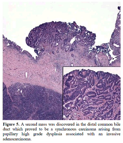 A rare synchrony of adenocarcinoma of the ampulla with an ileal