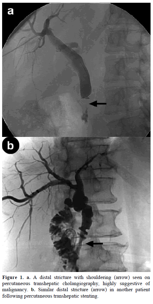 pancreas-distal-stricture-shouldering