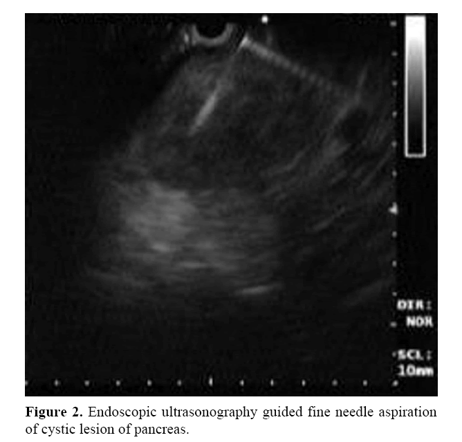 pancreas-endoscopic-ultrasonography