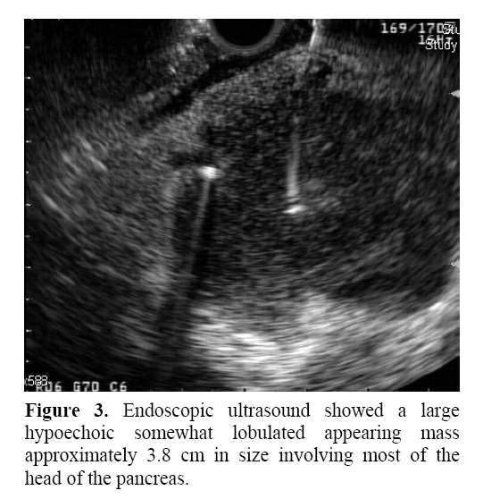 pancreas-endoscopic-ultrasound