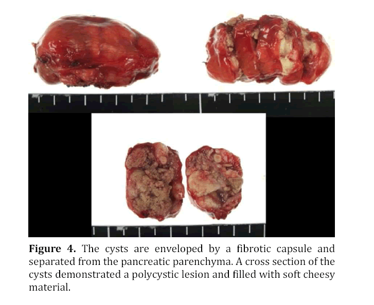 pancreas-enveloped-fibrotic-capsules