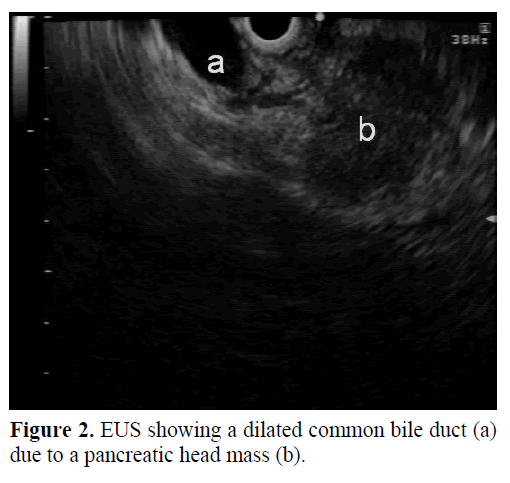 pancreas-eus-dilated-common-bile-duct