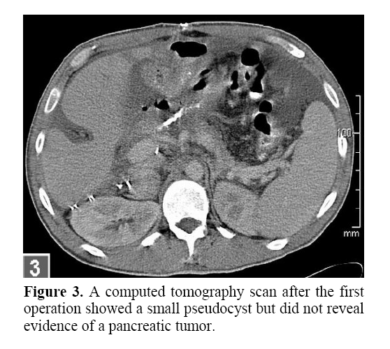 pancreas-evidence-pancreatic-tumor