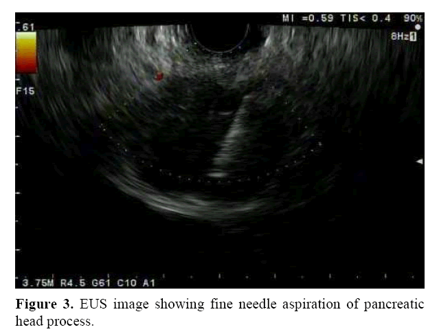 pancreas-fine-needle-aspiration