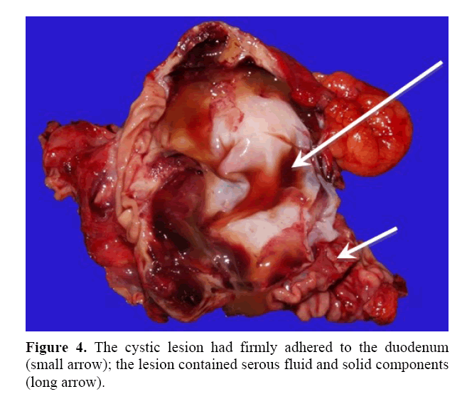 pancreas-firmly-adhered-duodenum