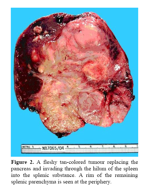 pancreas-fleshy-tan-colored-tumour