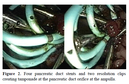 pancreas-four-pancreatic-duct-stents