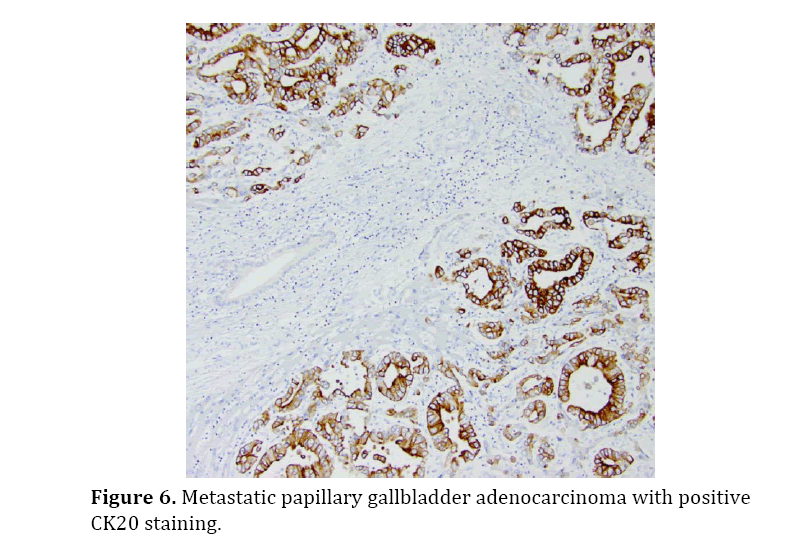 pancreas-gallbladder-papillary-adenocarcinoma