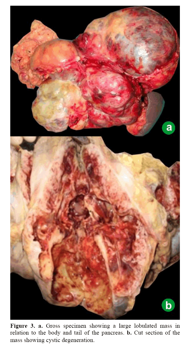 pancreas-gross-specimen