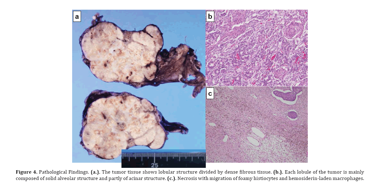 pancreas-hemosiderin-laden-macrophages