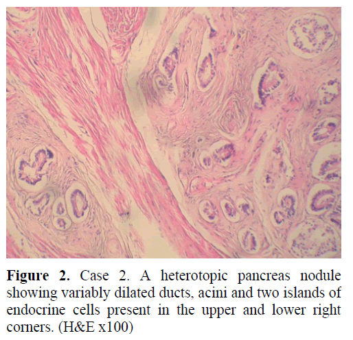 pancreas-heterotopic-pancreas-nodule