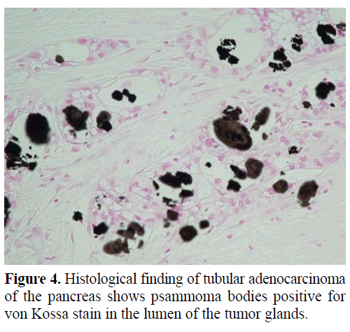 pancreas-histological-tubular-adenocarcinoma