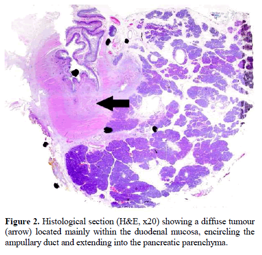 A rare synchrony of adenocarcinoma of the ampulla with an ileal