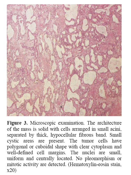 557px x 743px - Solid Serous Microcystic Tumor of the Pancreas