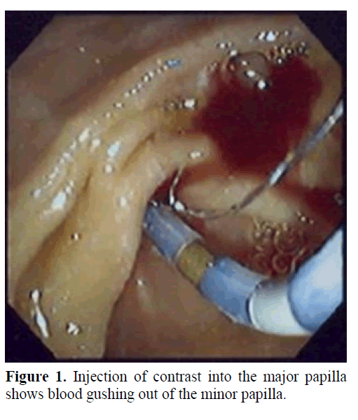 pancreas-injection-contrast-major-papilla
