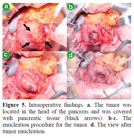 pancreas-intraoperative-findings-enucleation