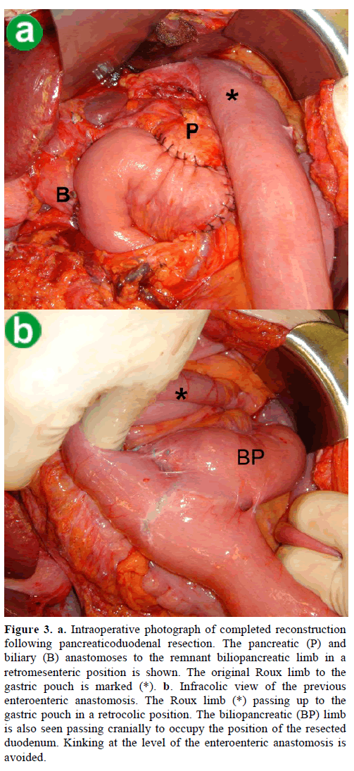 pancreas-intraoperative-photograph