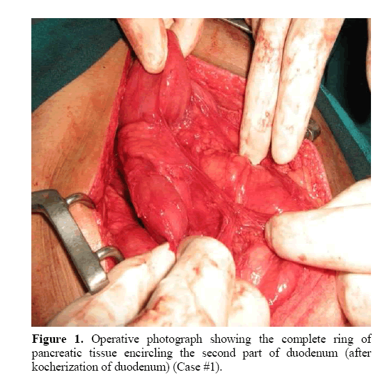 pancreas-kocherization-duodenum