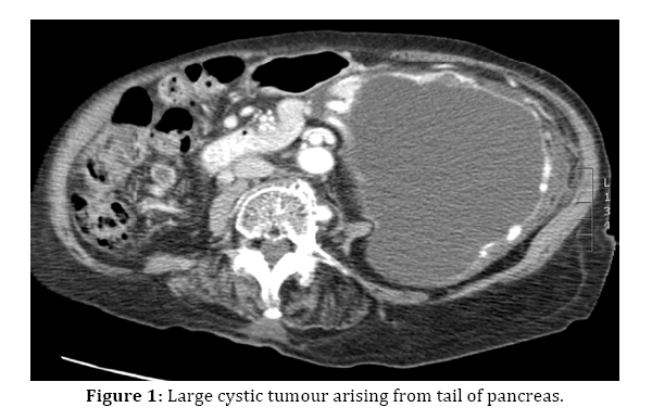 pancreas-large-cystic-tumour