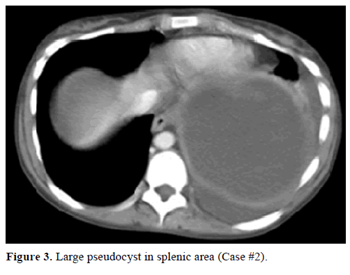 pancreas-large-pseudocyst-splenic-area