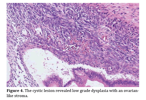 mucinous-cystic-neoplasm-of-the-pancreas-in-a-male-patient-diagno