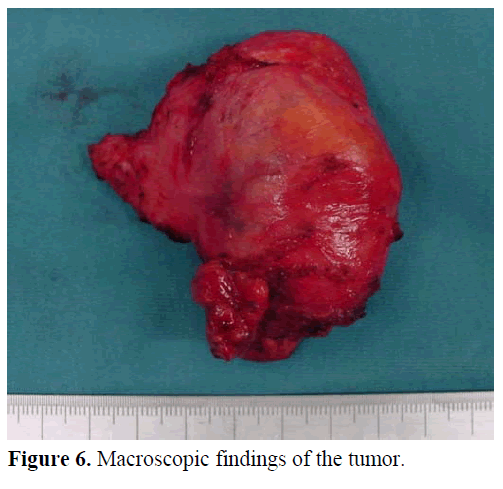 pancreas-macroscopic-findings-tumor
