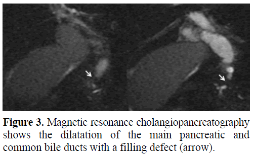 pancreas-magnetic-cholangiopancreatography
