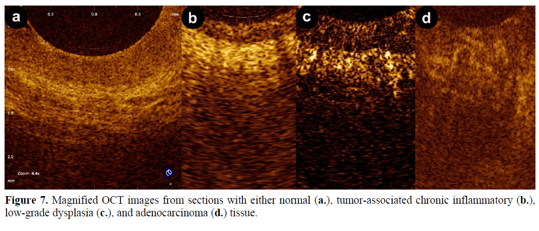 pancreas-magnified-oct-images-inflammatory