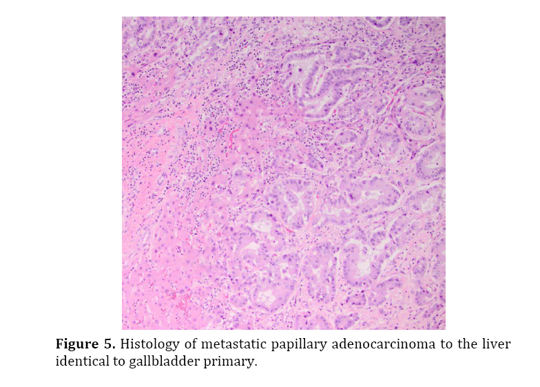 pancreas-metastatic-papillary-adenocarcinoma