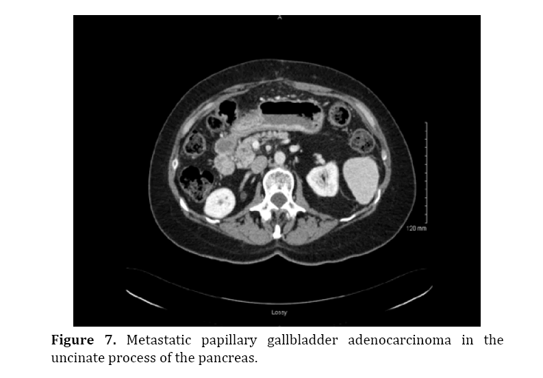 pancreas-metastatic-papillary-gallbladder