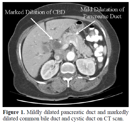 pancreas-mildly-dilated-pancreatic-duct
