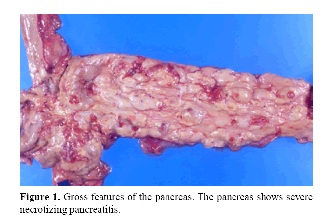 pancreas-necrotizing-pancreatitis