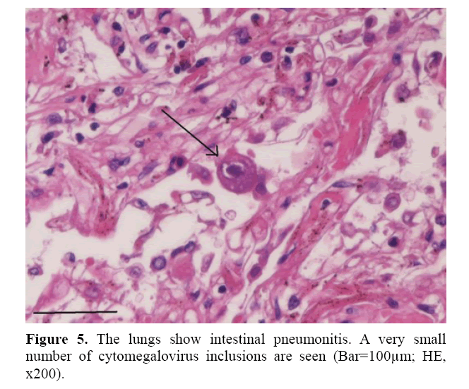 pancreas-number-cytomegalovirus-inclusions