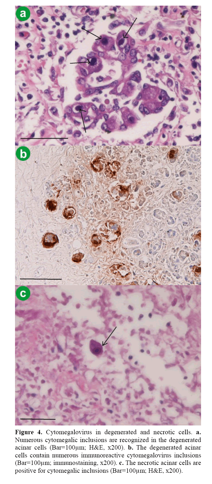 pancreas-numerous-cytomegalic-inclusions