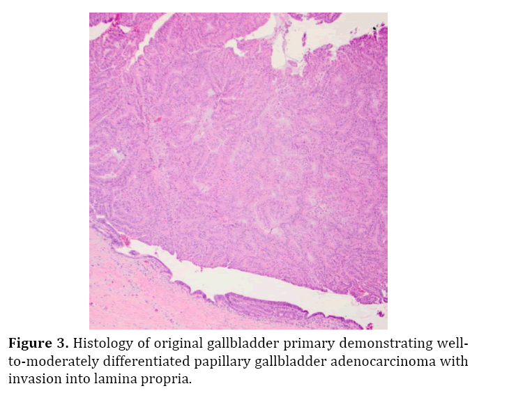 pancreas-original-gallbladder-primary