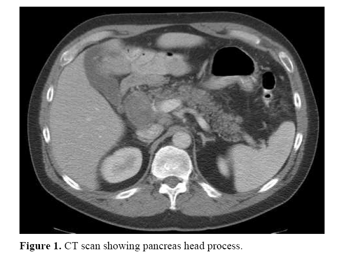 pancreas-pancreas-head-process