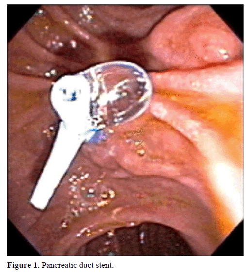 pancreas-pancreatic-duct-stent