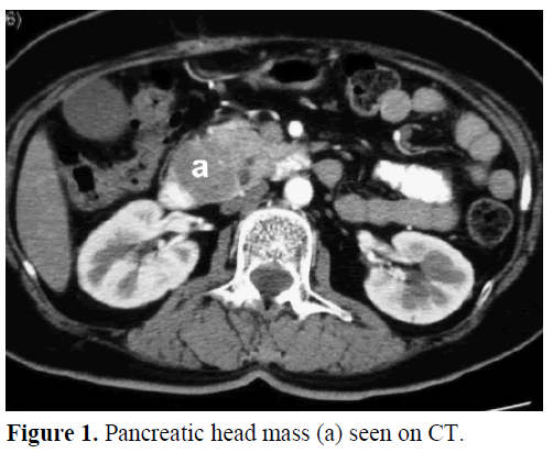 pancreas-pancreatic-head-mass-seen