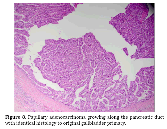 pancreas-papillary-adenocarcinoma-growing