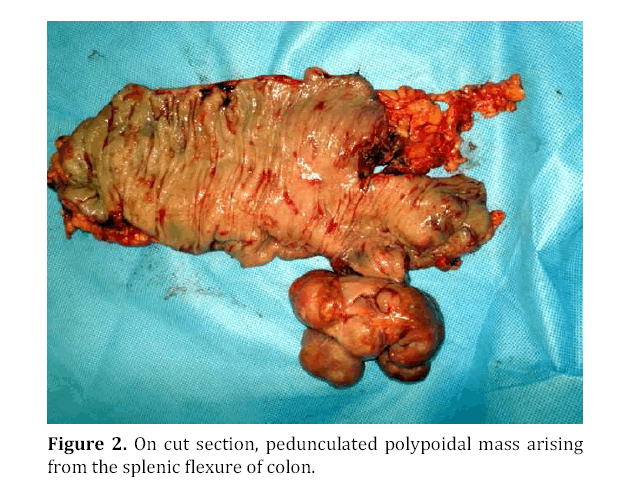 pancreas-pedunculated-polypoidal-mass