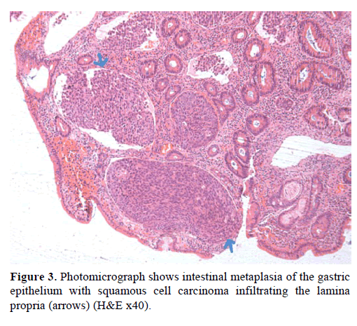 pancreas-photomicrograph-intestinal-metaplasia