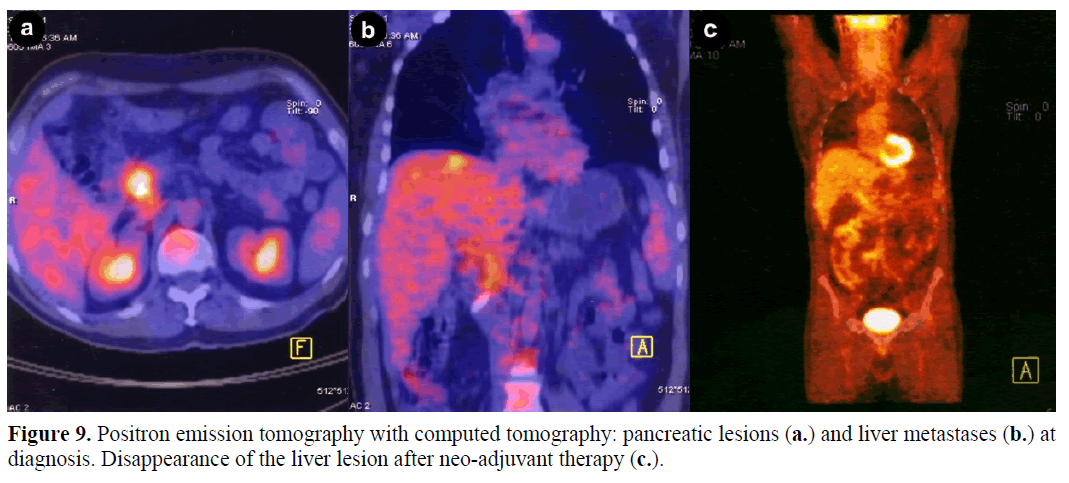 pancreas-positron-emission-tomography